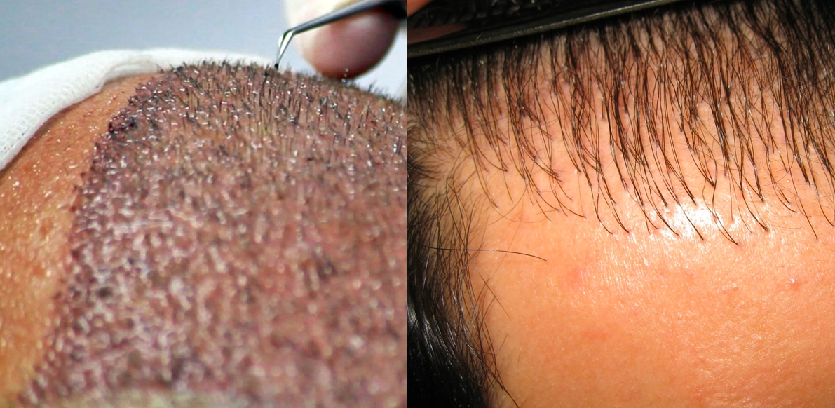 costo trapianto capelli - Preventivi e Interventi