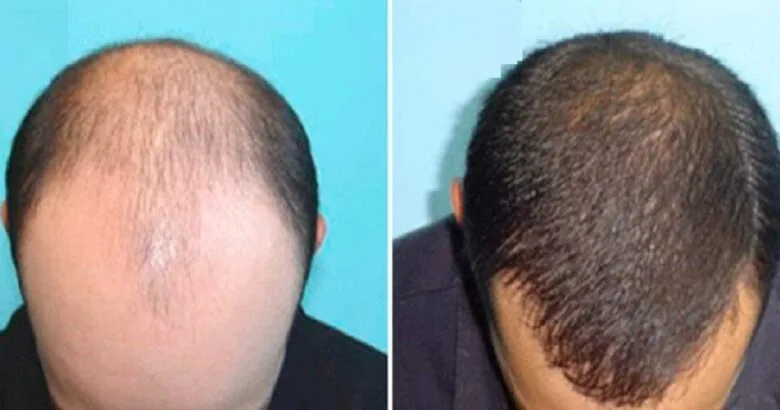 impianto capelli Turchia